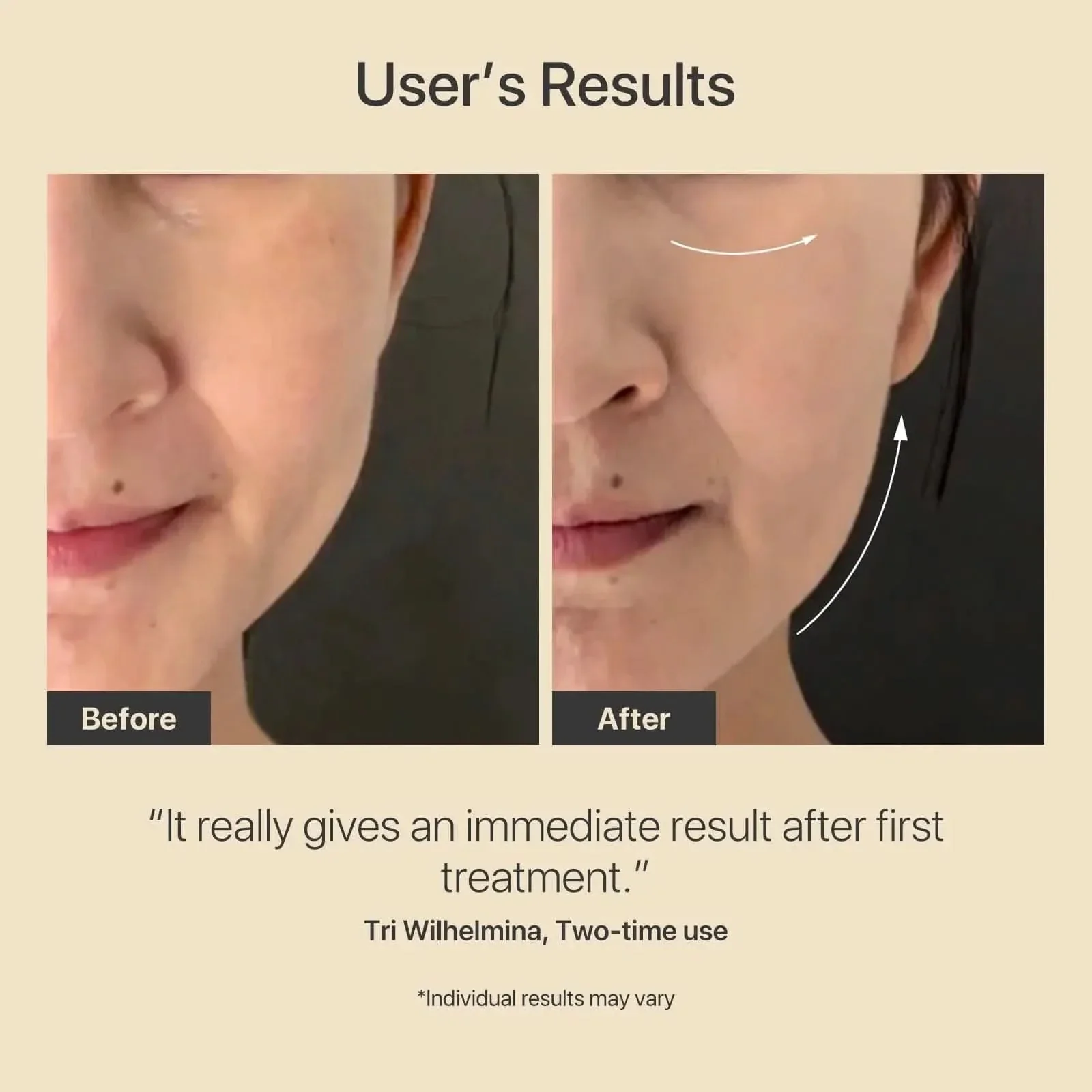 AMIRO R3 Turbo Facial RF Beauty Tool - Image 4
