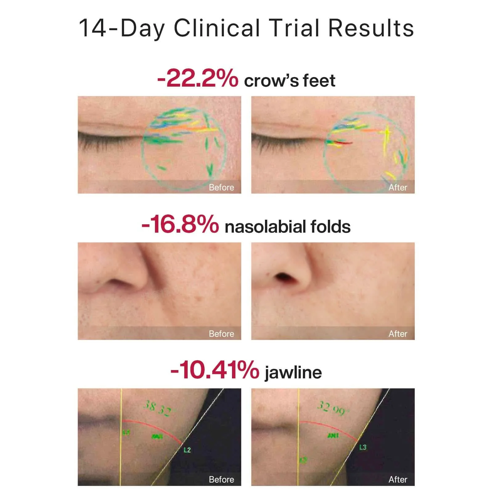 AMIRO R1 Lift Facial RF Skin Tightening Device - Image 4